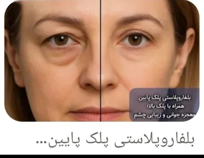 دکتر عمل بینی استخوانی دراصفهان