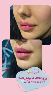 بهترین مرکز لاغری و امبدینگ اصفهان