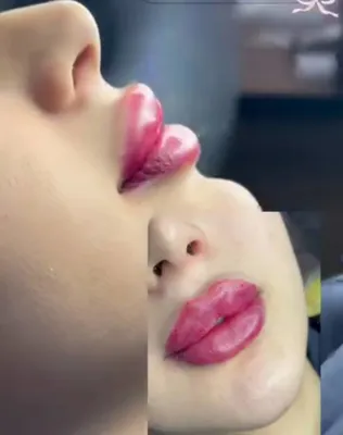تزریق ژل در فولادشهر