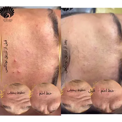 بوتاکس در فولادشهر