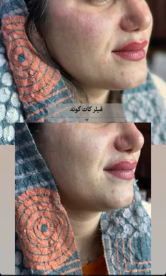 کات گونه در فولادشهر