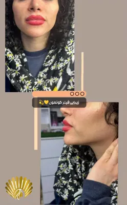 فیلر گونه در فولادشهر