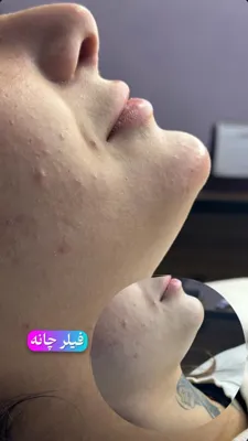 فیلر چانه در فولادشهر