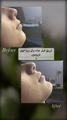 فیلر لب در فولادشهر