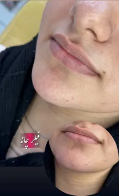 ژل لب در فولادشهر