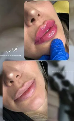 بهترین فیلر لب در فولادشهر