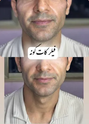 فیلر گونه در فولادشهر