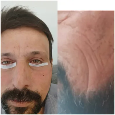 طبيب التجميل يختص بتحسين الشكل الخارجي أو إصلاح عيوب خلقية أو ناتجة عن حوادث أو تقدم بالعمر، ومن أشهر الإجراءات:
👃 تجميل الأنف (Rhinoplasty)
تعديل شكل الأنف أو تحسين التنفس أو تصحيح انحراف الحاجز الأنفي.
👁️ شد الجفون (بلفارو بلاستي)
إزالة ترهل الجفون أو الانتفاخات تحت العين لتحسين الشكل والرؤية أحياناً.
💉 حقن الفيلر والبوتوكس
لإزالة التجاعيد، تعبئة الخدود أو الشفاه، وتحسين ملامح الوجه بشكل غير جراحي.
🧴 تأثير الدهون تحت الجلد
الدهون في الوجه أو الجسم ممكن تعطي امتلاء طبيعي، أو أحياناً تسبب ترهل أو عدم تناسق، لذلك يتم شفطها أو إعادة توزيعها حسب الحاجة.
🤝 أبو يعقوب السوداني يكون معك خطوة بخطوة، يترجم لك كل التفاصيل بينك وبين الطبيب، حتى تفهم المخاطر، النتائج، وفترة التعافي بشكل واضح قبل أي قرار.