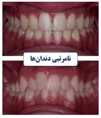 بهترین کامپوزیت دندان تبریز