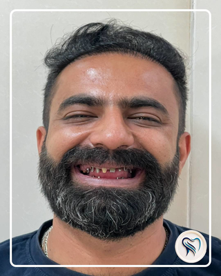 ایمپلنت در اصفهان
