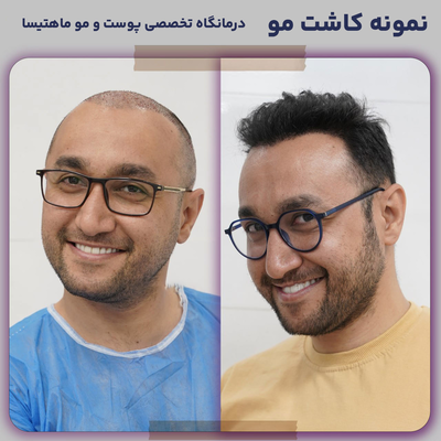 کلینیک کاشت مو و ابرو ماهتیسا
