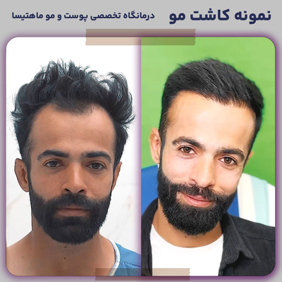 کلینیک کاشت مو و ابرو ماهتیسا