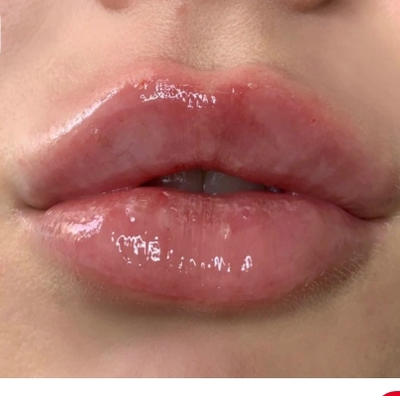 تزريق ژل و بوتاکس در نارمک 