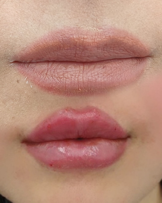 تزريق ژل و بوتاکس در نارمک 