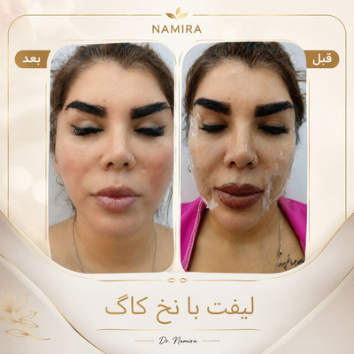 تزريق ژل و بوتاکس در نارمک&nbsp;