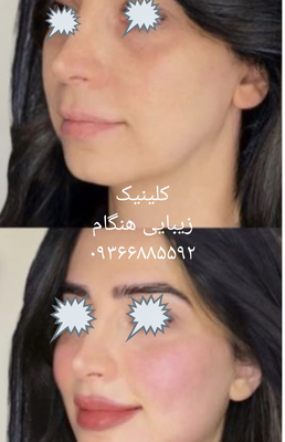 تزريق ژل و بوتاکس در نارمک 