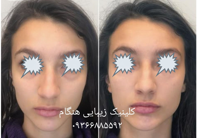 تزريق ژل و بوتاکس در نارمک 