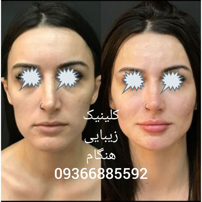 تزريق ژل و بوتاکس در نارمک 