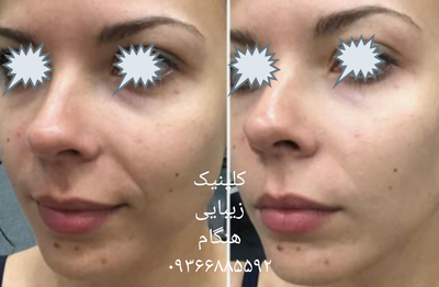 تزريق ژل و بوتاکس در نارمک 