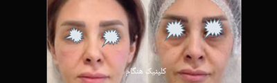 تزريق ژل و بوتاکس در نارمک 