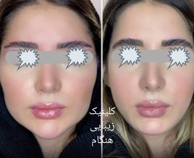 تزريق ژل و بوتاکس در نارمک 