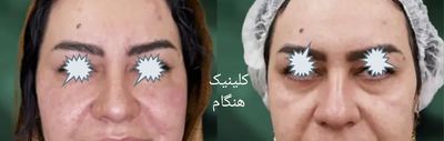 تزريق ژل و بوتاکس در نارمک 