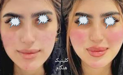 تزريق ژل و بوتاکس در نارمک 