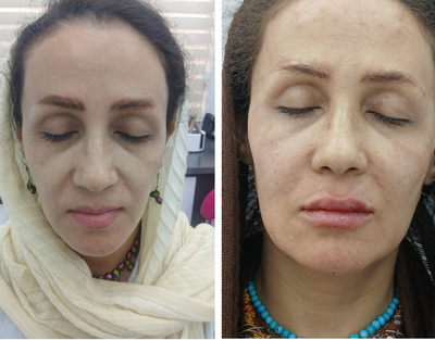 تزريق ژل و بوتاکس در نارمک 