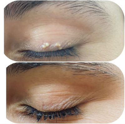 برداشت ضایعه پوستی