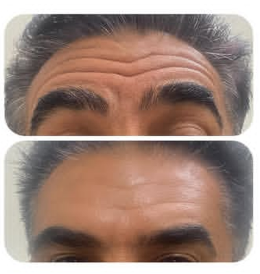 بوتاکس خطوط پیشانی
