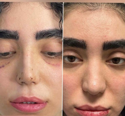 نمونه کار جراح بینی خوب در شیراز