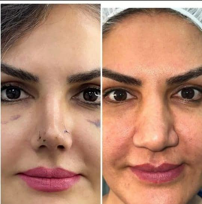 نمونه کار جراحی بینی طبیعی در شیراز