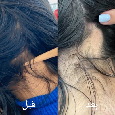 درمان ریزش مو در شیراز&nbsp;